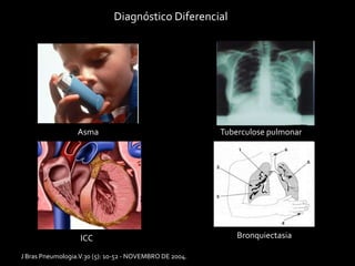 Diagnóstico Diferencial
Asma
ICC
Tuberculose pulmonar
Bronquiectasia
J Bras Pneumologia.V.30 (5): 10-52 - NOVEMBRO DE 2004.
 