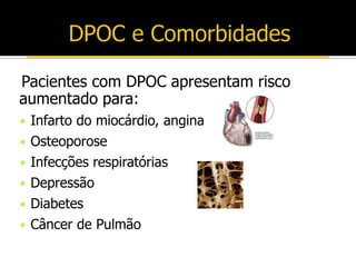 Pacientes com DPOC apresentam risco
aumentado para:
• Infarto do miocárdio, angina
• Osteoporose
• Infecções respiratórias
• Depressão
• Diabetes
• Câncer de Pulmão
 