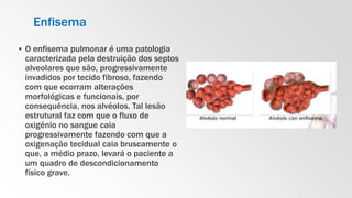 Enfisema
▪ O enfisema pulmonar é uma patologia
caracterizada pela destruição dos septos
alveolares que são, progressivamente
invadidos por tecido fibroso, fazendo
com que ocorram alterações
morfológicas e funcionais, por
consequência, nos alvéolos. Tal lesão
estrutural faz com que o fluxo de
oxigênio no sangue caia
progressivamente fazendo com que a
oxigenação tecidual caia bruscamente o
que, a médio prazo, levará o paciente a
um quadro de descondicionamento
físico grave.
 