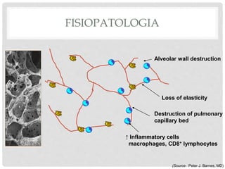 FISIOPATOLOGIA
Alveolar wall destruction
Loss of elasticity
Destruction of pulmonary
capillary bed
↑ Inflammatory cells
macrophages, CD8+ lymphocytes
(Source: Peter J. Barnes, MD)
 
