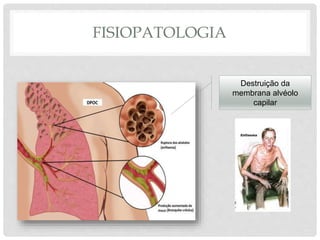 FISIOPATOLOGIA
Destruição da
membrana alvéolo
capilar
 