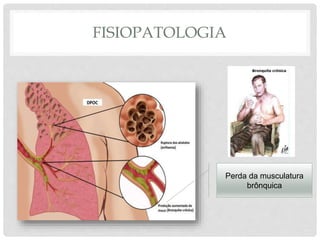 FISIOPATOLOGIA
Perda da musculatura
brônquica
 