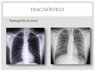 DIAGNÓSTICO
• Radiografia de tórax
 