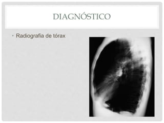 DIAGNÓSTICO
• Radiografia de tórax
 