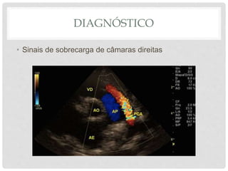 DIAGNÓSTICO
• Sinais de sobrecarga de câmaras direitas
 
