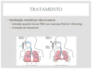 TRATAMENTO
• Ventilação mecânica não-invasiva
• Indicada quando houver RNC por narcose (PaCo2 >45mmhg)
• Correção da hipoxemia
 