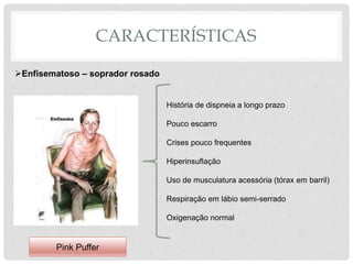 CARACTERÍSTICAS
Enfisematoso – soprador rosado
História de dispneia a longo prazo
Pouco escarro
Crises pouco frequentes
Hiperinsuflação
Uso de musculatura acessória (tórax em barril)
Respiração em lábio semi-serrado
Oxigenação normal
Pink Puffer
 