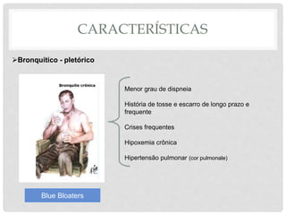 CARACTERÍSTICAS
Bronquítico - pletórico
Menor grau de dispneia
História de tosse e escarro de longo prazo e
frequente
Crises frequentes
Hipoxemia crônica
Hipertensão pulmonar (cor pulmonale)
Blue Bloaters
 