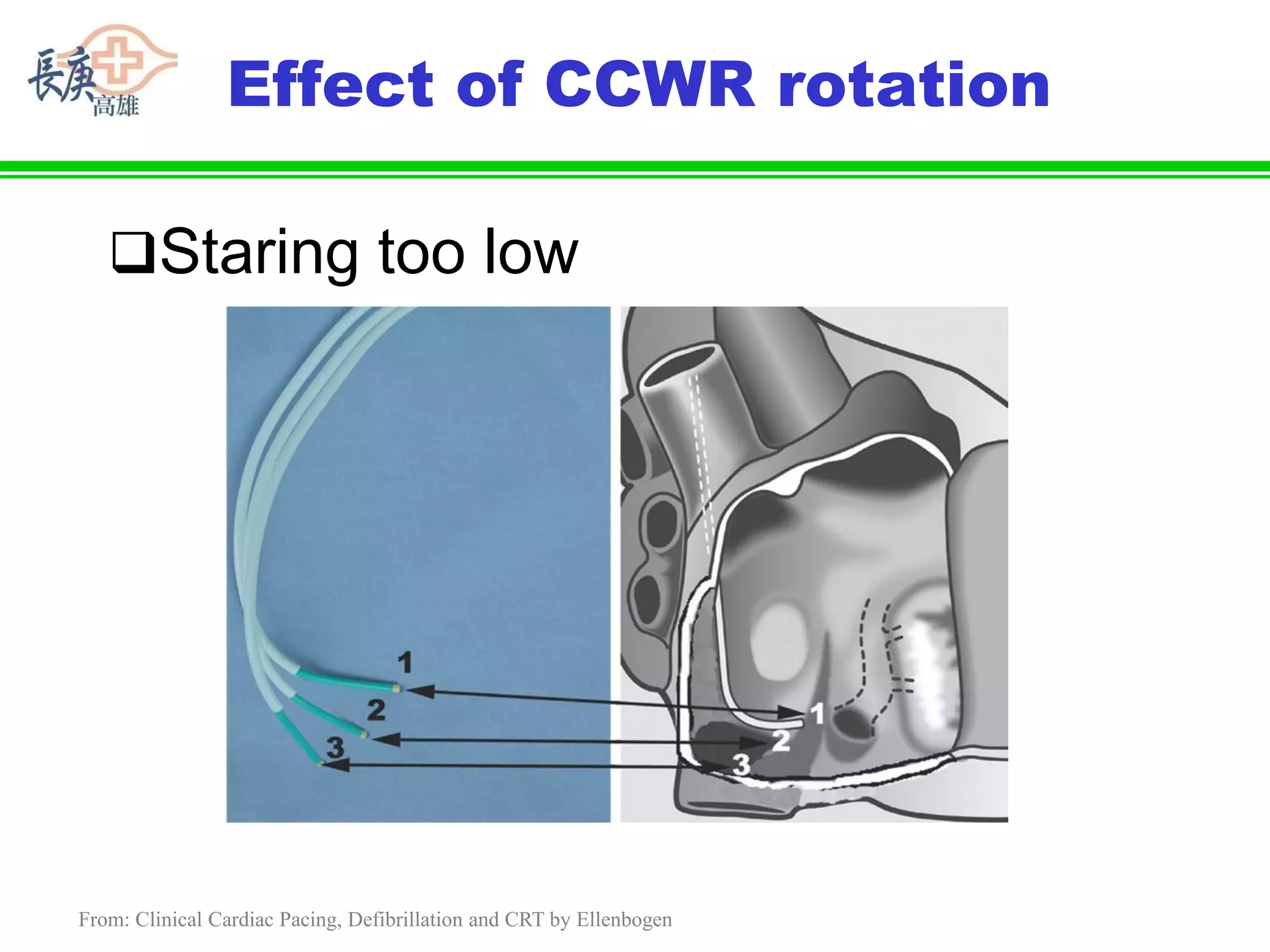 Pre-Procedural Preparation and CRT Implantation Tips and Tricks | PDF