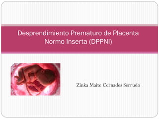 Desprendimiento Prematuro de Placenta
Normo Inserta (DPPNI)

Zinka Maite Cernades Serrudo

 