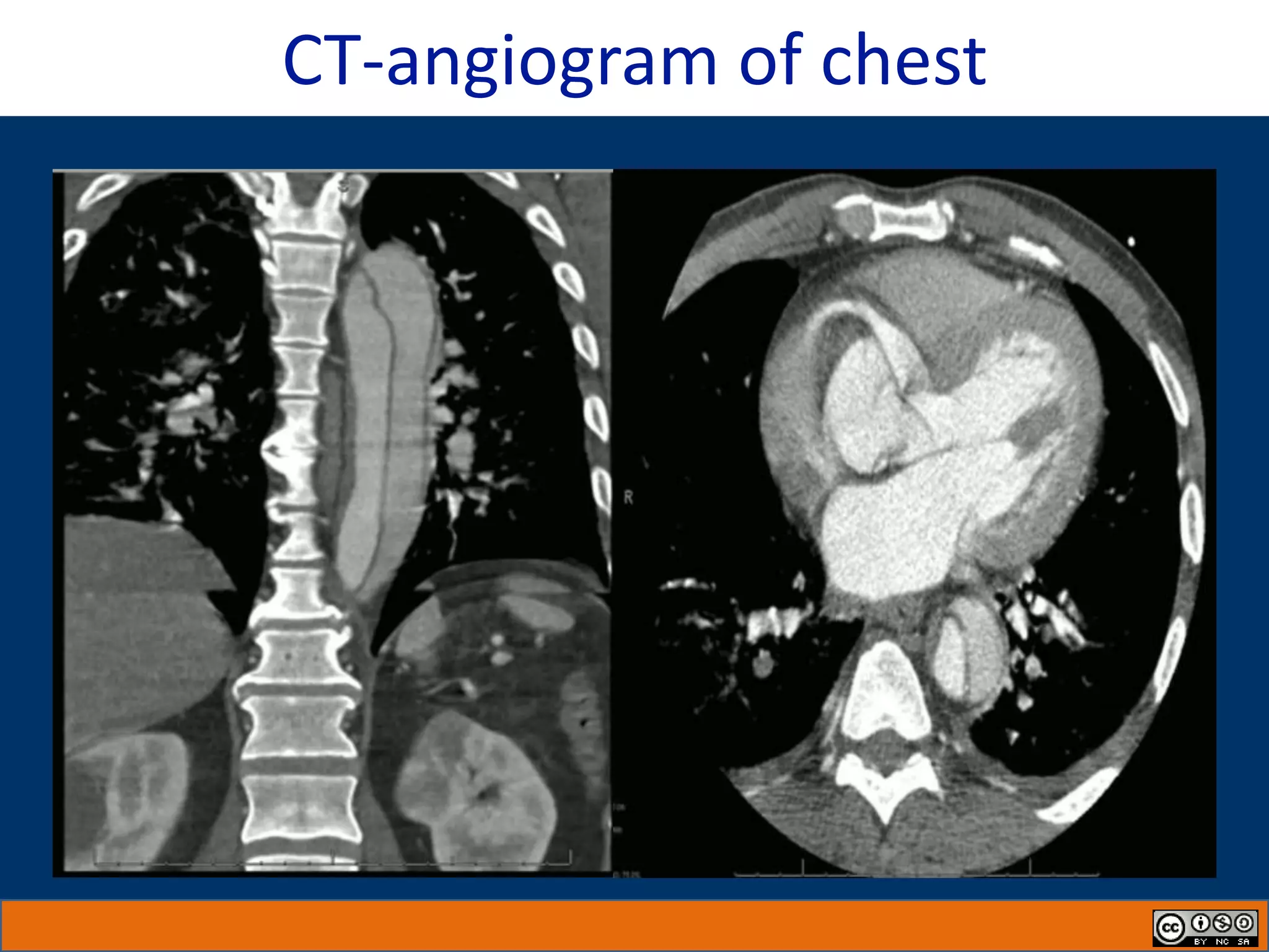 CT-angiogram of chest
 