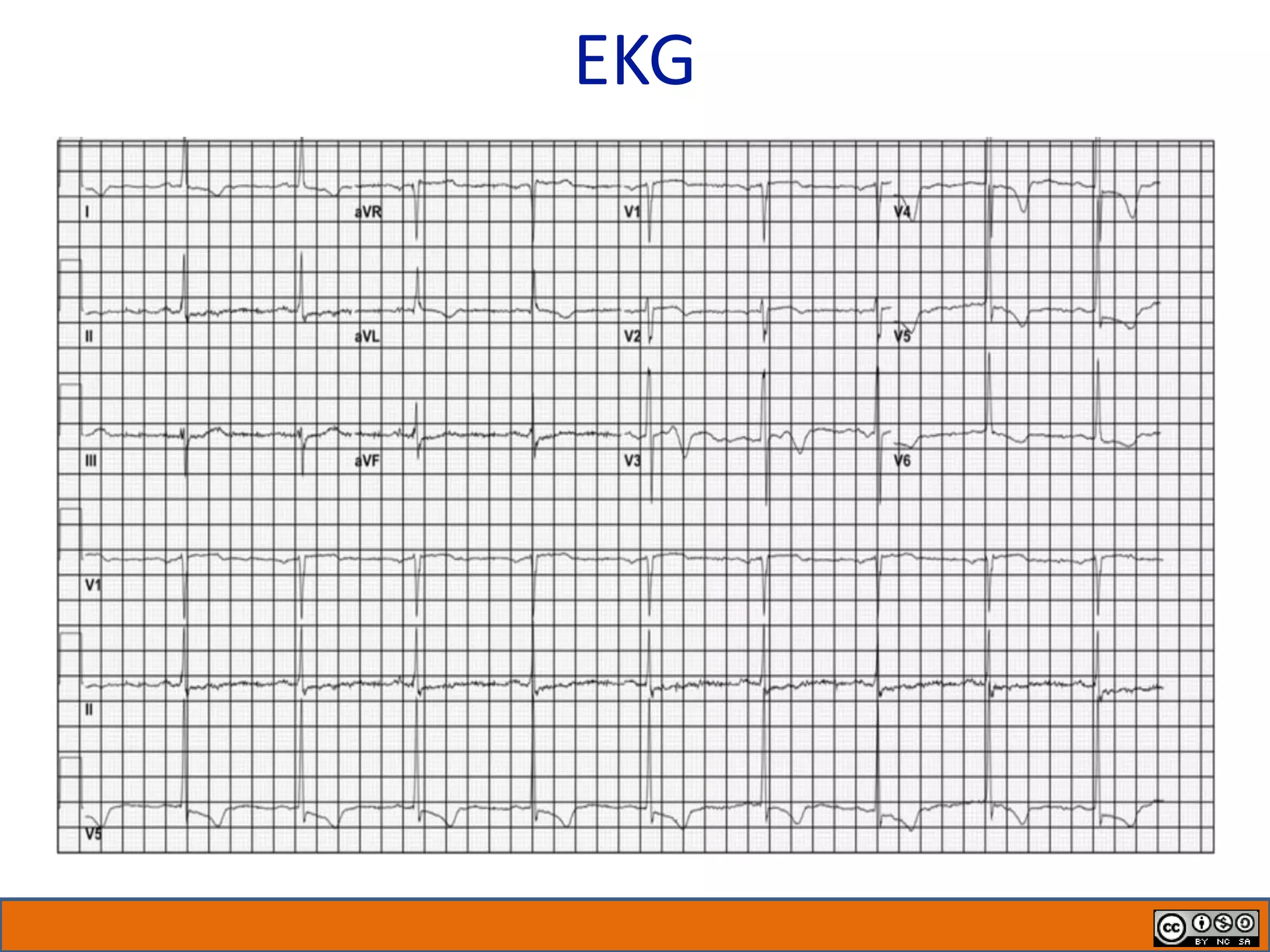 EKG
 