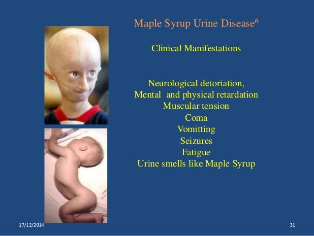 maple syrup urine disease icd 10 maple syrup urine disease icd 10