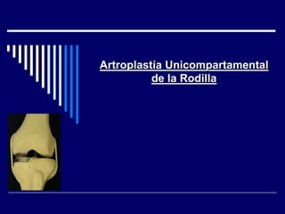 Artroplastía Unicompartamental
de la Rodilla
 