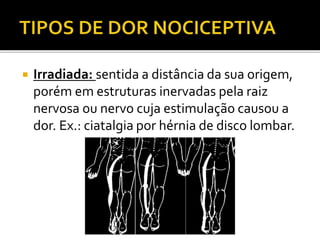 Irradiada: sentida a distância da sua origem,
porém em estruturas inervadas pela raiz
nervosa ou nervo cuja estimulação causou a
dor. Ex.: ciatalgia por hérnia de disco lombar.
 