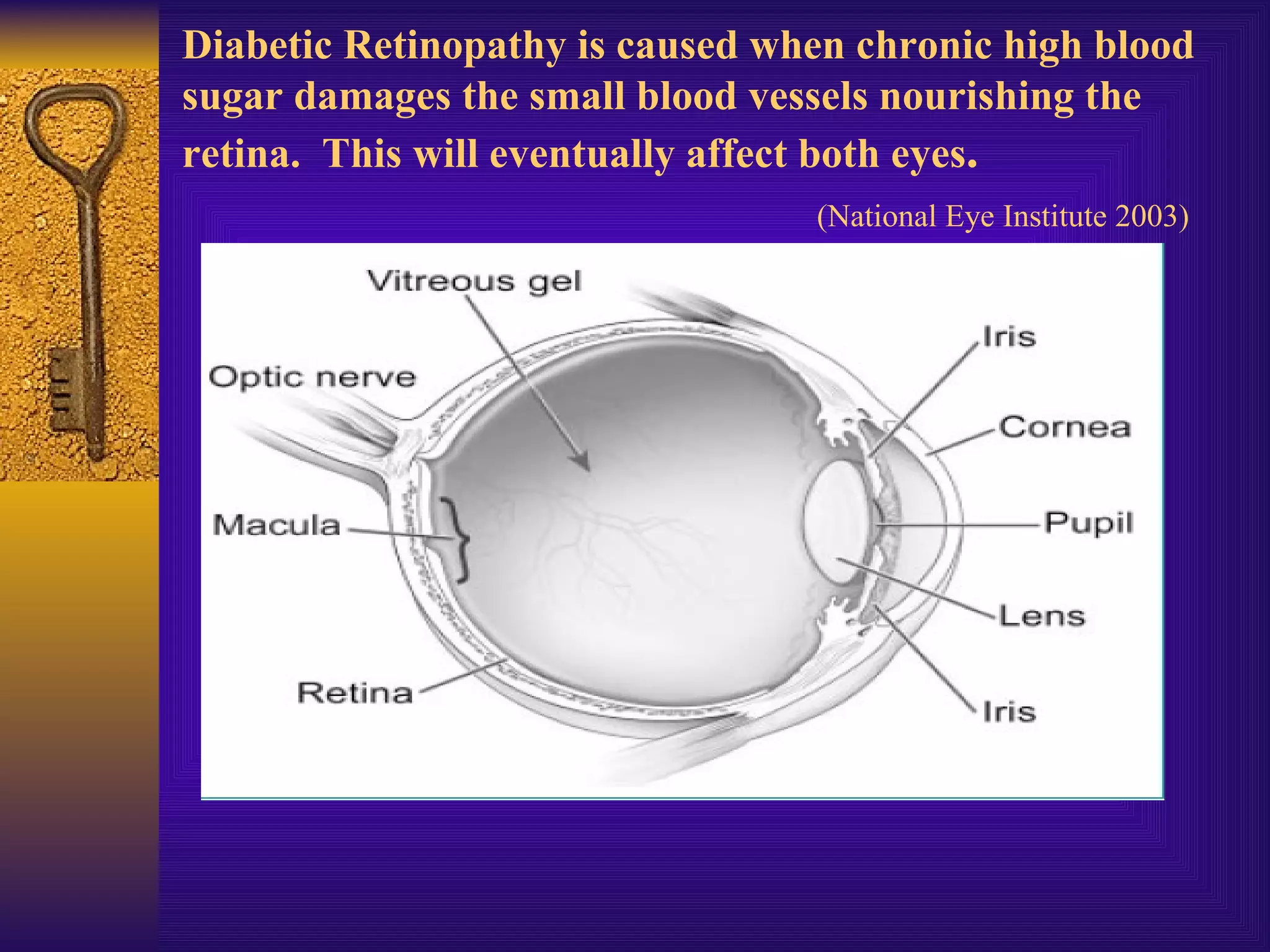 Diabetic Retinopathy is caused when chronic high blood sugar damages the small blood vessels nourishing the retina.  This will eventually affect both eyes .     (National Eye Institute 2003)   