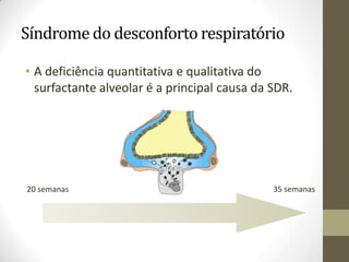 • A deficiência quantitativa e qualitativa do
surfactante alveolar é a principal causa da SDR.
Síndrome do desconforto respiratório
20 semanas 35 semanas
 