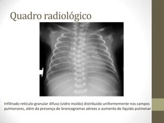 Quadro radiológico
Infiltrado retículo-granular difuso (vidro moído) distribuído uniformemente nos campos
pulmonares, além da presença de broncogramas aéreos e aumento de líquido pulmonar
 