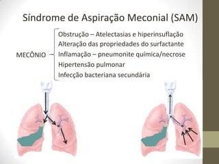 Síndrome de Aspiração Meconial (SAM)
MECÔNIO
Obstrução – Atelectasias e hiperinsuflação
Inflamação – pneumonite química/necrose
Infecção bacteriana secundária
Hipertensão pulmonar
Alteração das propriedades do surfactante
 