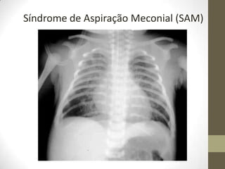 Síndrome de Aspiração Meconial (SAM)
 