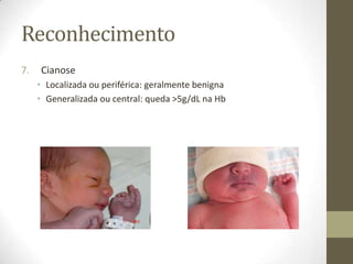 Reconhecimento
7. Cianose
• Localizada ou periférica: geralmente benigna
• Generalizada ou central: queda >5g/dL na Hb
 