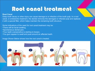Root canal treatment
Root Canal
Deep tooth decay or other injury can cause damage to or infection of the tooth pulp. In a root
canal, or endodontic treatment, the dentist removes the damaged or infected pulp and replaces
it with a special ﬁller, which helps maintain the remaining tooth structure.
Some indications of the need for root canal treatment may be:
•There will be facial swelling,
•Spontaneous dental pain,
•Your teeth oversensitive is starting to loosen,
•You gum appear to swell and puss around an affected teeth.
Image Shown Below shows how the root canal is treated.
 