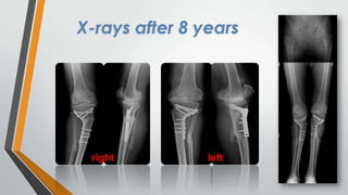 X-rays after 8 years

right

left

 