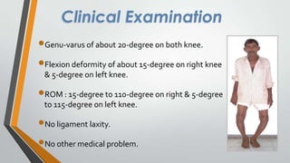 Clinical Examination
Genu-varus of about 20-degree on both knee.

Flexion deformity of about 15-degree on right knee
& 5-degree on left knee.

ROM : 15-degree to 110-degree on right & 5-degree
to 115-degree on left knee.

No ligament laxity.
No other medical problem.

 