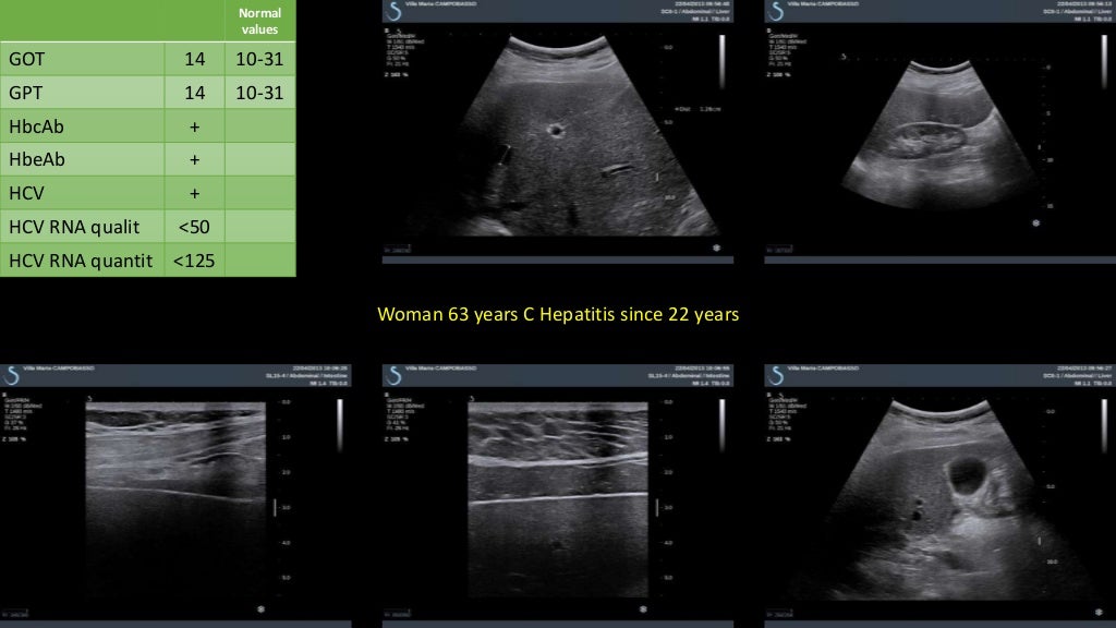 Dr. masciotra liver shear wave elastography clinical cases