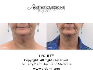 Before

After

LIPOLIFTTM
Copyright. All Rights Reserved.
Dr. Jerry Darm Aesthetic Medicine
www.drdarm.com

 