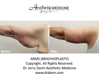 Before

After

ARMS (BRACHIOPLASTY)
Copyright. All Rights Reserved.
Dr. Jerry Darm Aesthetic Medicine
www.drdarm.com

 