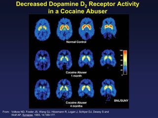 Decreased Dopamine D2 Receptor Activity
in a Cocaine Abuser

From: Volkow ND, Fowler JS, Wang GJ, Hitzemann R, Logan J, Schlyer DJ, Dewey S and
Wolf AP, Synapse, 1993, 14:169-177.

 