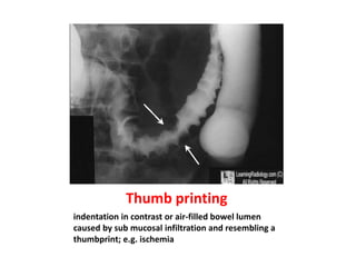 Thuumprint Sign Dr.laith notes about common radiological signs | PPTX