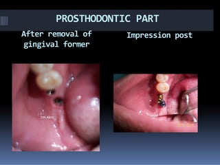After removal of
gingival former
Impression post
PROSTHODONTIC PART
 