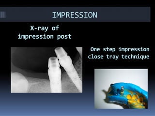 IMPRESSION
X-ray of
impression post
One step impression
close tray techniqueclose tray technique
 