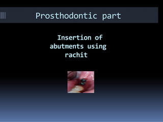 Prosthodontic part
Insertion of
abutments using
rachit
 