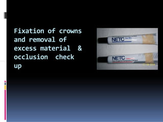 Fixation of crowns
and removal of
excess material &
occlusion check
up
 