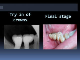 Try in of
crowns
Final stage
 