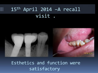 15th April 2014 –A recall
visit .
Esthetics and function were
satisfactory
 