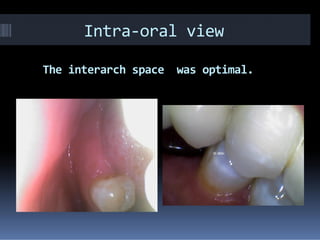 Intra-oral view
was optimal.spaceThe interarch
 
