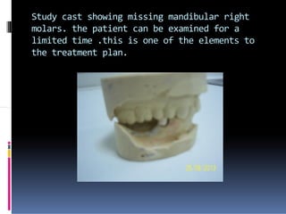 Study cast showing missing mandibular right
molars. the patient can be examined for a
limited time .this is one of the elements to
the treatment plan.
 