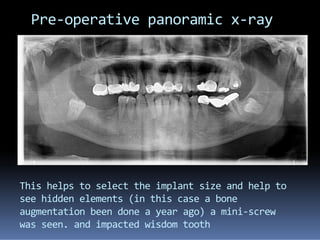Pre-operative panoramic x-ray
This helps to select the implant size and help to
see hidden elements (in this case a bone
augmentation been done a year ago) a mini-screw
was seen. and impacted wisdom tooth
 
