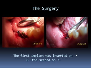The Surgery
The first implant was inserted on
6 .the second on 7.
 