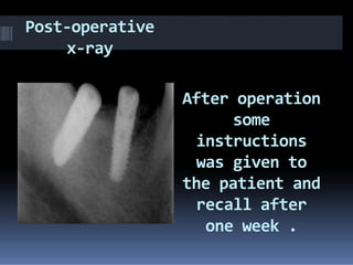 Post-operative
x-ray
After operation
some
instructionsinstructions
was given to
the patient and
recall after
one week .
 