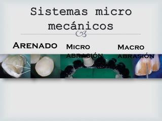
Sistemas micro
mecánicos
Arenado Micro
abrasión
Macro
abrasión
 