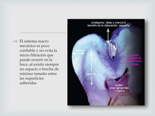 
 El sistema macro
mecánico es poco
confiable y no evita la
micro filtración que
puede ocurrir en la
boca ,al existir siempre
un espacio o brecha de
mínimo tamaño entre
las superficies
adheridas
 