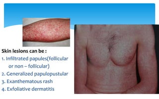 Skin lesions can be :
1. Infiltrated papules(follicular
or non – follicular)
2. Generalized papulopustular
3. Exanthematous rash
4. Exfoliative dermatitis
 