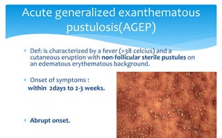  Def: is characterized by a fever (>38 celcius) and a
cutaneous eruption with non-follicular sterile pustules on
an edematous erythematous background.
 Onset of symptoms :
within 2days to 2-3 weeks.
 Abrupt onset.
Acute generalized exanthematous
pustulosis(AGEP)
 