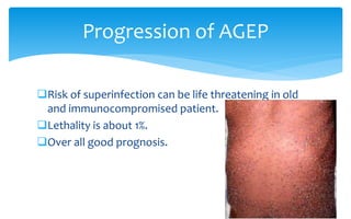 Risk of superinfection can be life threatening in old
and immunocompromised patient.
Lethality is about 1%.
Over all good prognosis.
Progression of AGEP
 