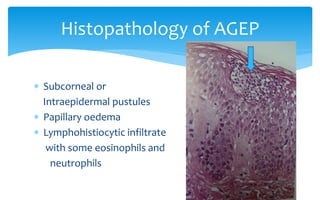  Subcorneal or
Intraepidermal pustules
 Papillary oedema
 Lymphohistiocytic infiltrate
with some eosinophils and
neutrophils
Histopathology of AGEP
 